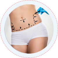 Liposuction Tummy Tuck