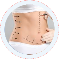 Liposuction Tummy Tuck