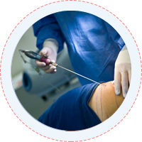 Liposuction Tummy Tuck