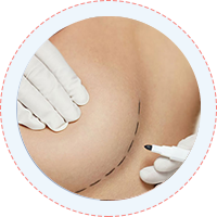 Breast Enhancement Surgery