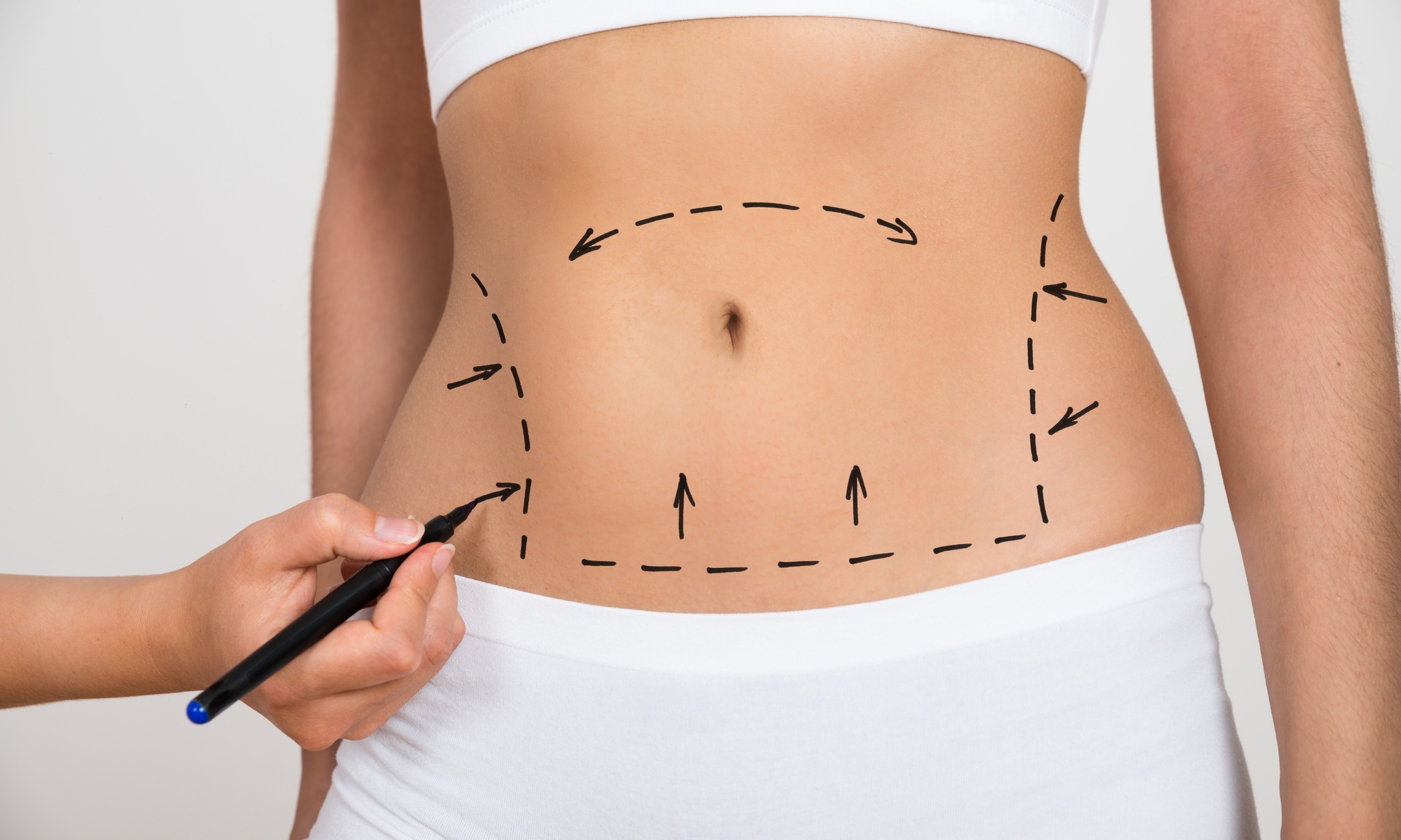 Abdominoplasty Singapore