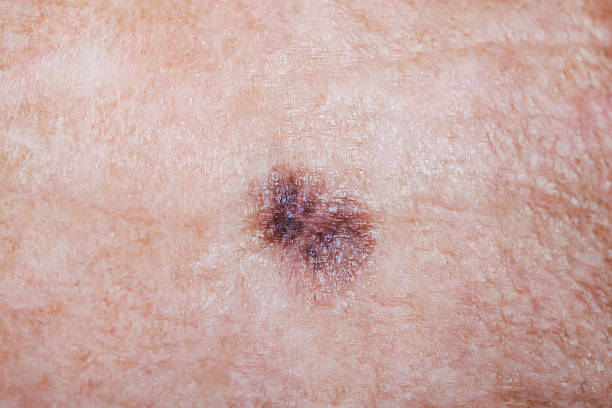 Mole Removal Surgery